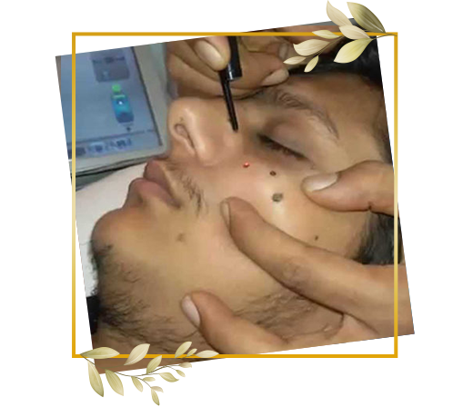 Men’s wart removal treatment performed using precision device during facial skin care procedure