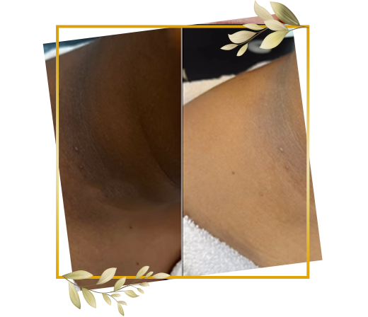 Neck brightening service at TrendMi Salon reducing dark patches and improving skin tone.