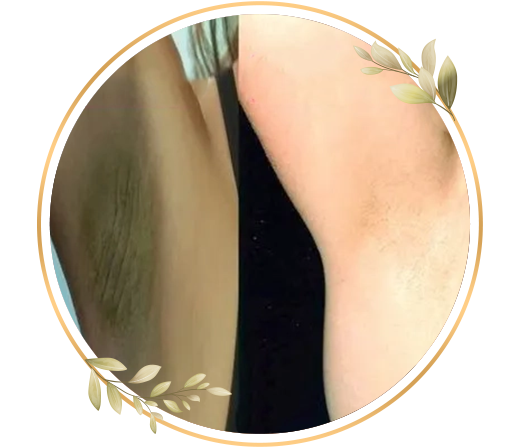 Underarms bleach service at TrendMi Salon helping reduce dark patches and improve skin tone.