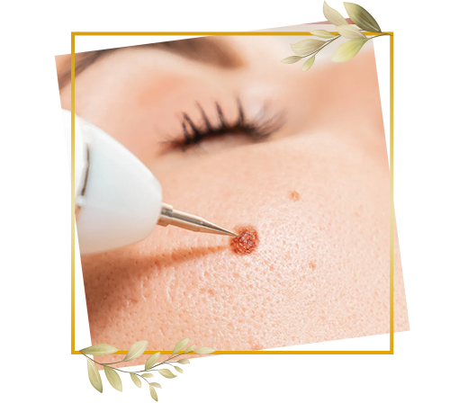 Skin wart removal procedure at TrendMi Salon handled carefully to maintain hygiene and improve skin appearance.